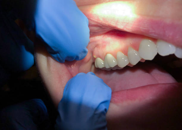 Best Emergency Dentist for Knocked-Out Tooth in Stonewood, WV